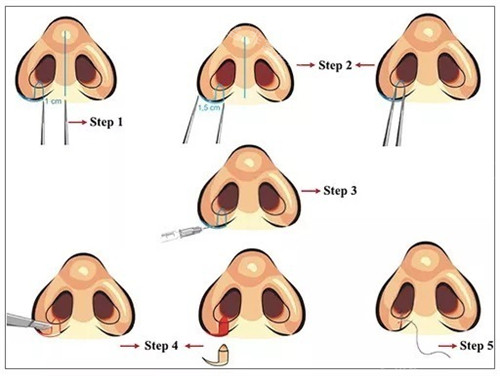 鼻翼缩小手术前后对比