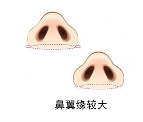 鼻翼肥大切除术