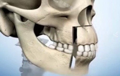 正颌手术图示