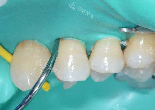 橡皮障在补牙中的运用