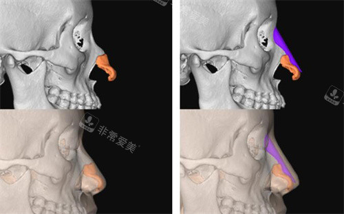 FITme3D鼻假体使用对比展示