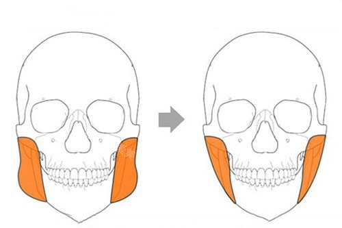 咬肌切除卡通对比图