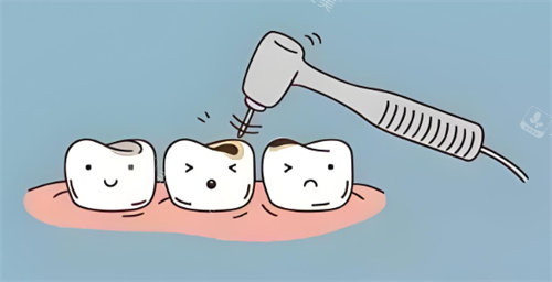 龋齿治疗动画展示图