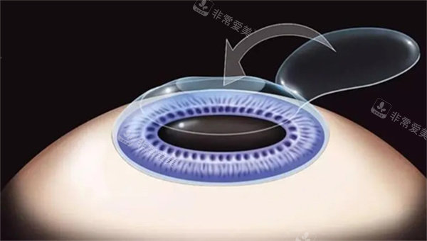 近视手术操作动画图