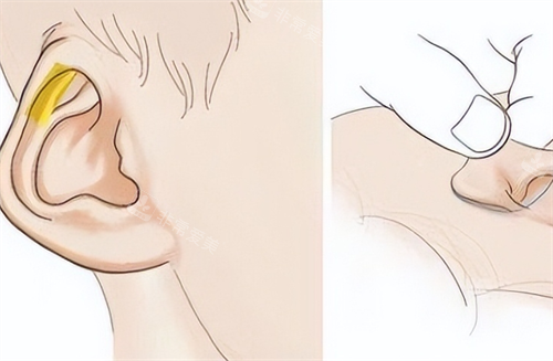 耳再造耳部畸形动画展示