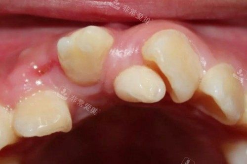 牙齿畸形问题模型图