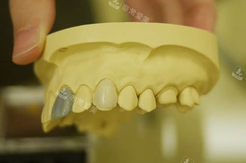 牙齿模具