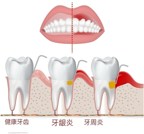健康牙齿和牙龈炎