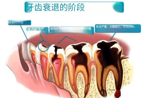 牙齿衰退阶段图
