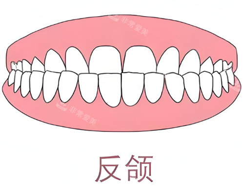 牙齿反颌卡通示意图