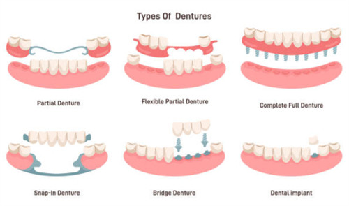 牙齿缺失示意图