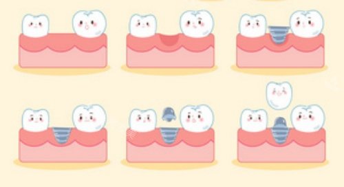 种牙流程示意图
