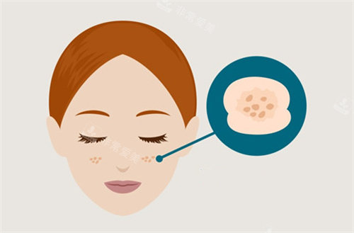 雀斑卡通图片
