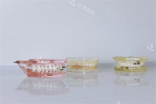 牙齿模型示意展示