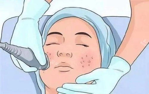 激光面部祛痣示意图