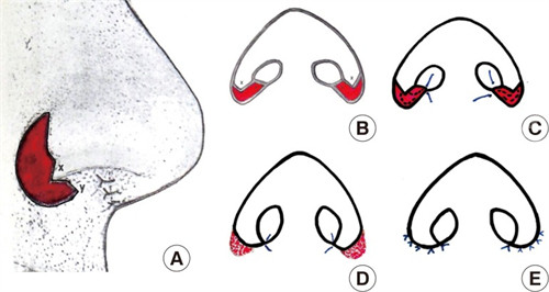 鼻翼缩小手术部位