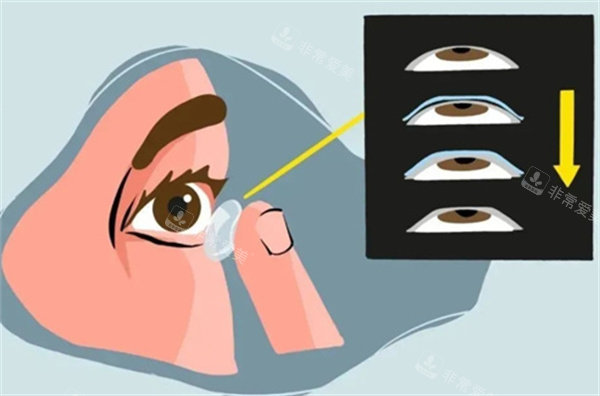ok镜佩戴过程