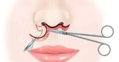 埋线人中缩短术手术过程图解