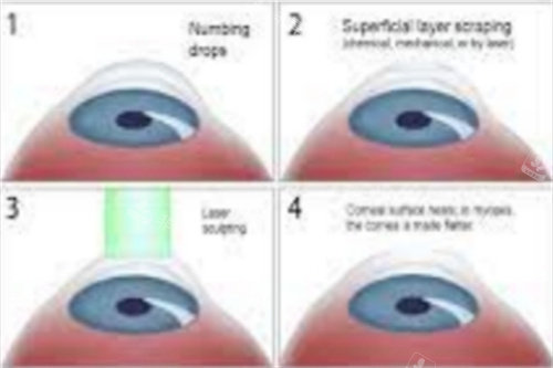 smart全激光手术过程