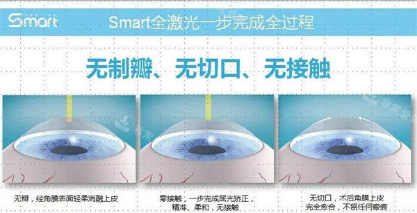 smart全激光手术过程图