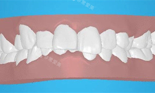 牙齿深覆合卡通图