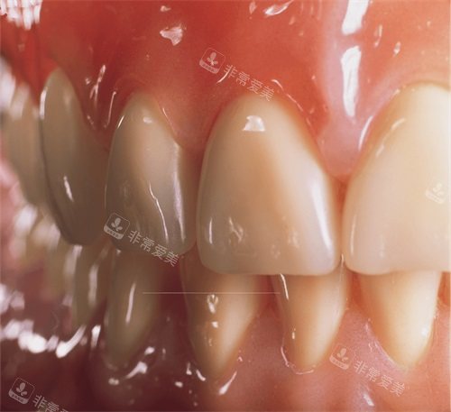 吸附性义齿牙齿细节展示图