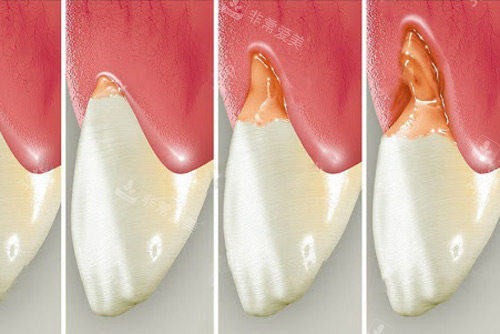 牙齿楔状缺损图