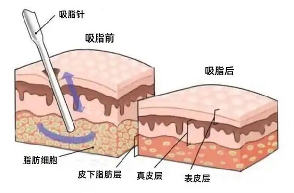 面部吸脂图