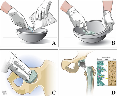 骨水泥修补过程