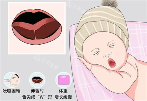 舌系带过短判断