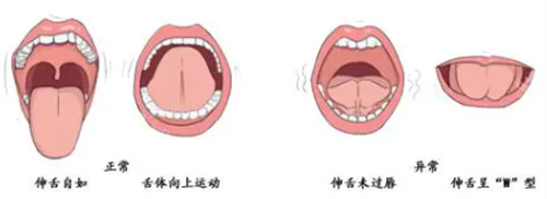 舌系带过短与正常舌头区别