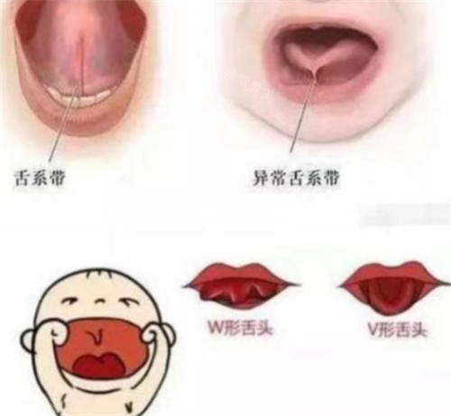 舌系带过短的样子图片