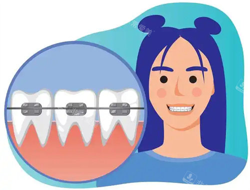 儿童牙齿矫正卡通图