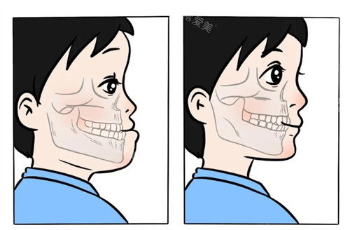 地包天矫正前后对比图