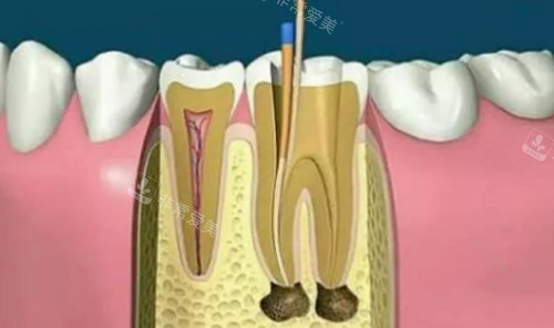 根管治疗动画演示