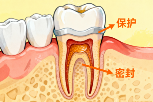 根管治疗卡通展示图