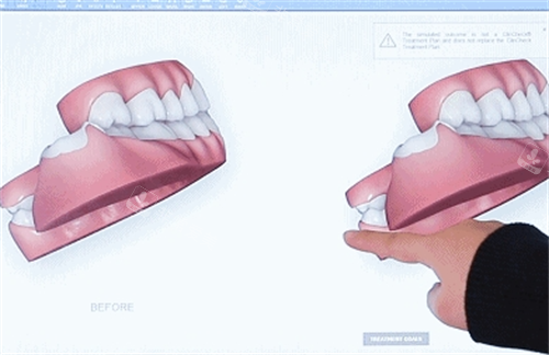 隐形牙齿矫正3D模型展示