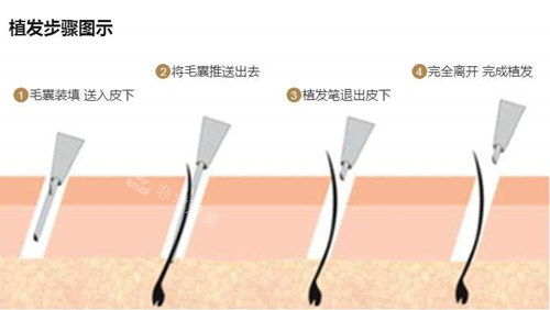 植发笔植发步骤
