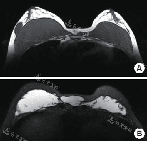 不明注射物在胸部的样子