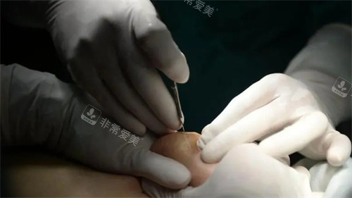 不明注射物取出手术中