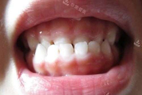 儿牙地包天模型图