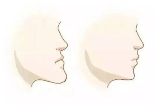 反颌卡通对比图