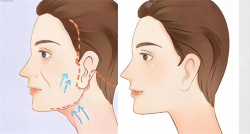 分享我在韩国做面部提拉的真实经历，全程体验超舒服，做完轮廓紧致很多，整个人都年轻了