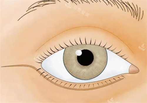 下睑外翻手术切口