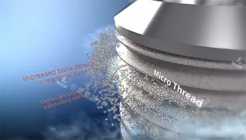 沃兰种植牙表面材料图