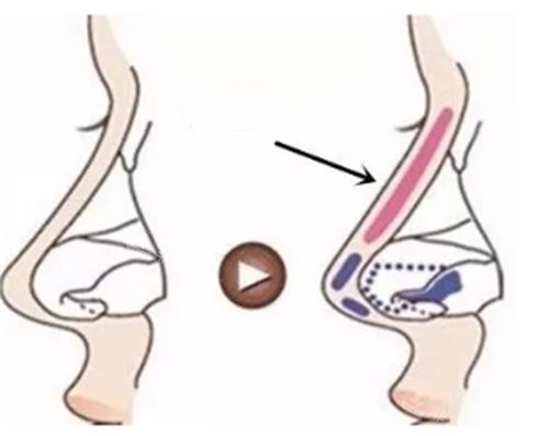 分段式隆鼻示意图