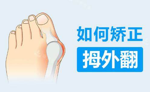 如何矫正拇外翻
