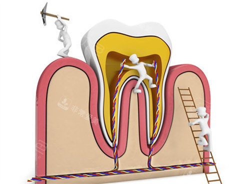根管治疗卡通图展示