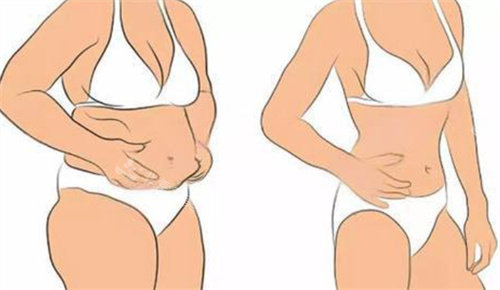 吸脂前后卡通图