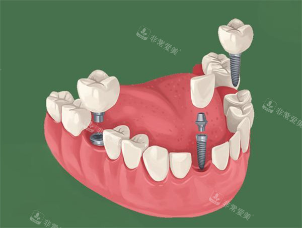 种植牙卡通动画图展示